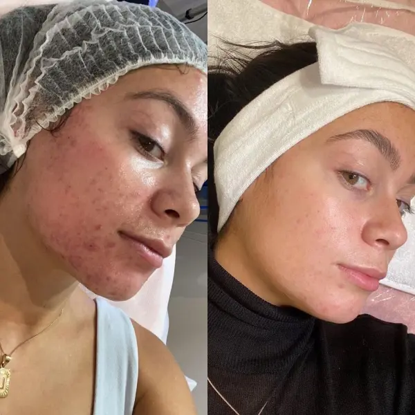 Hydrafacial "Soin Deluxe" — visuel 3
